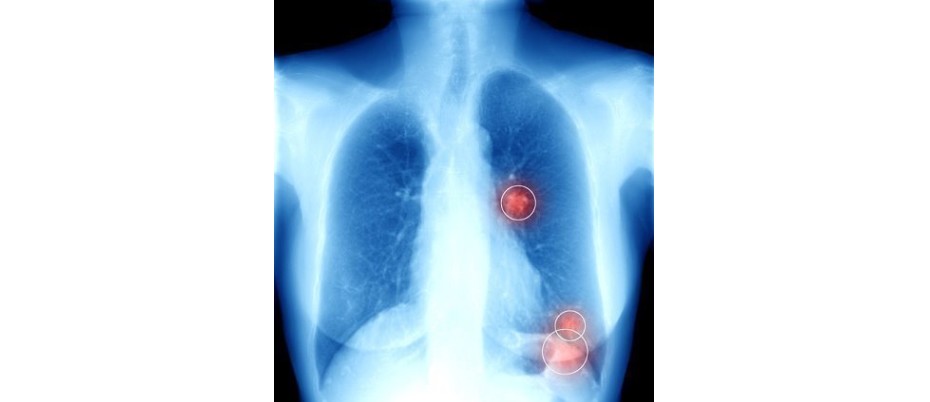 Artificial intelligence can support doctor diagnosis by detecting pulmonary nodules
