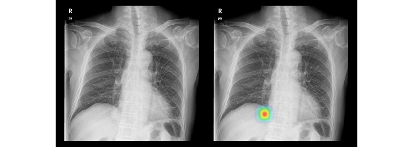 Interpretability AI 상업화: 루닛 적용사례