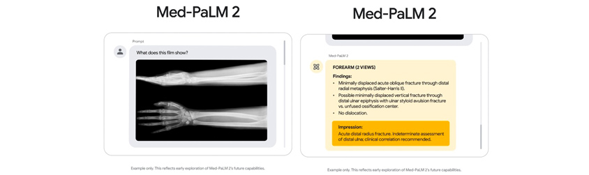 Med-PaLM 2 예시