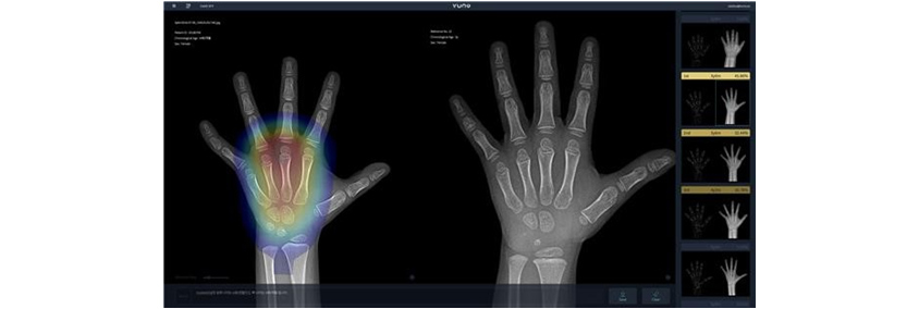 뷰노메드 본에이지(VUNO Med-Bone Age)를 활용한 AI 뼈 나이 진단 화면